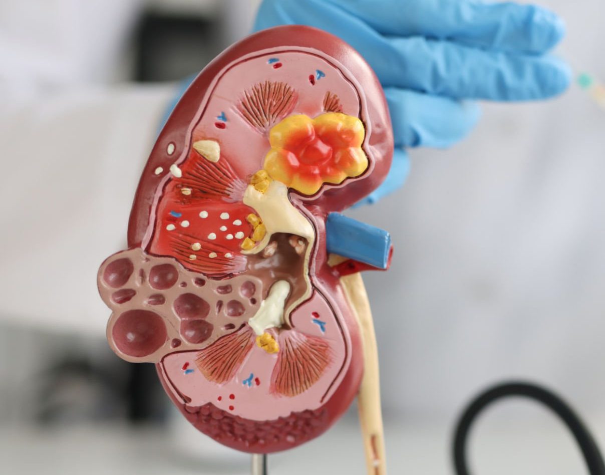 Tratamiento para Cáncer de Riñón | Urovida Mallorca